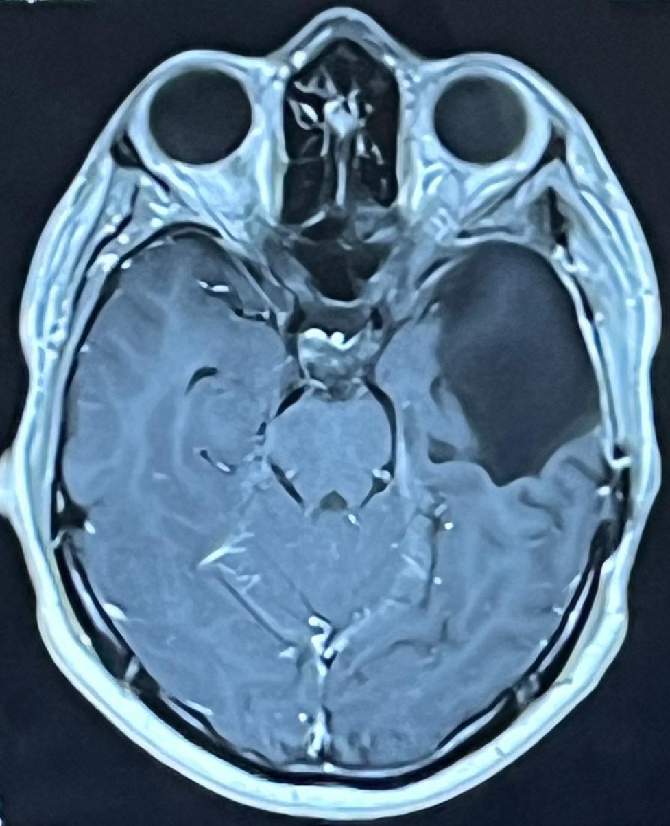 Hunter’s brain scan, with the tumor clearly visible.